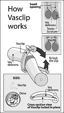 vasclip chart